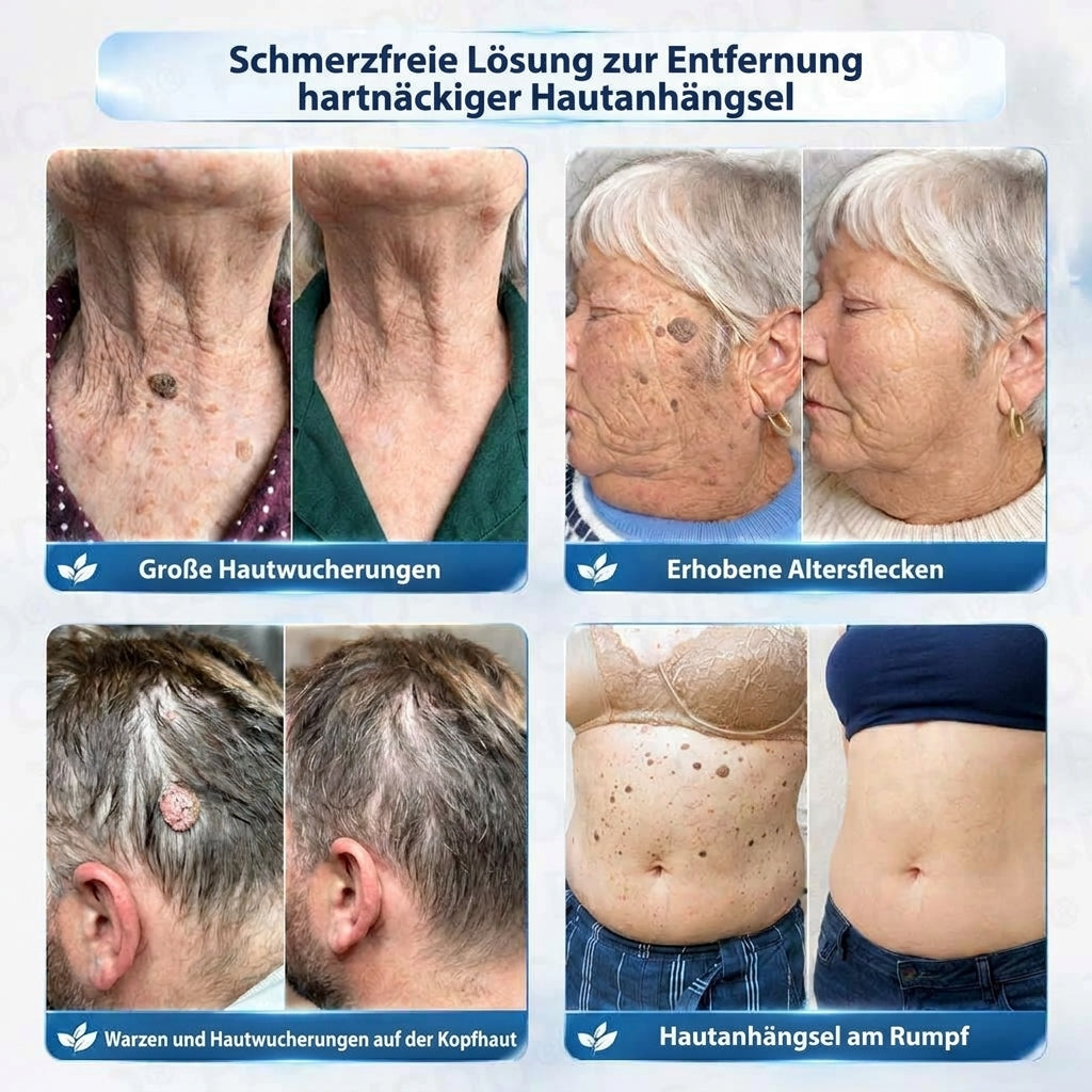 HISKIN®🧑‍⚕️ 7-Tage-Repair-Creme gegen Stielwarzen & Pigmentflecken🍒
